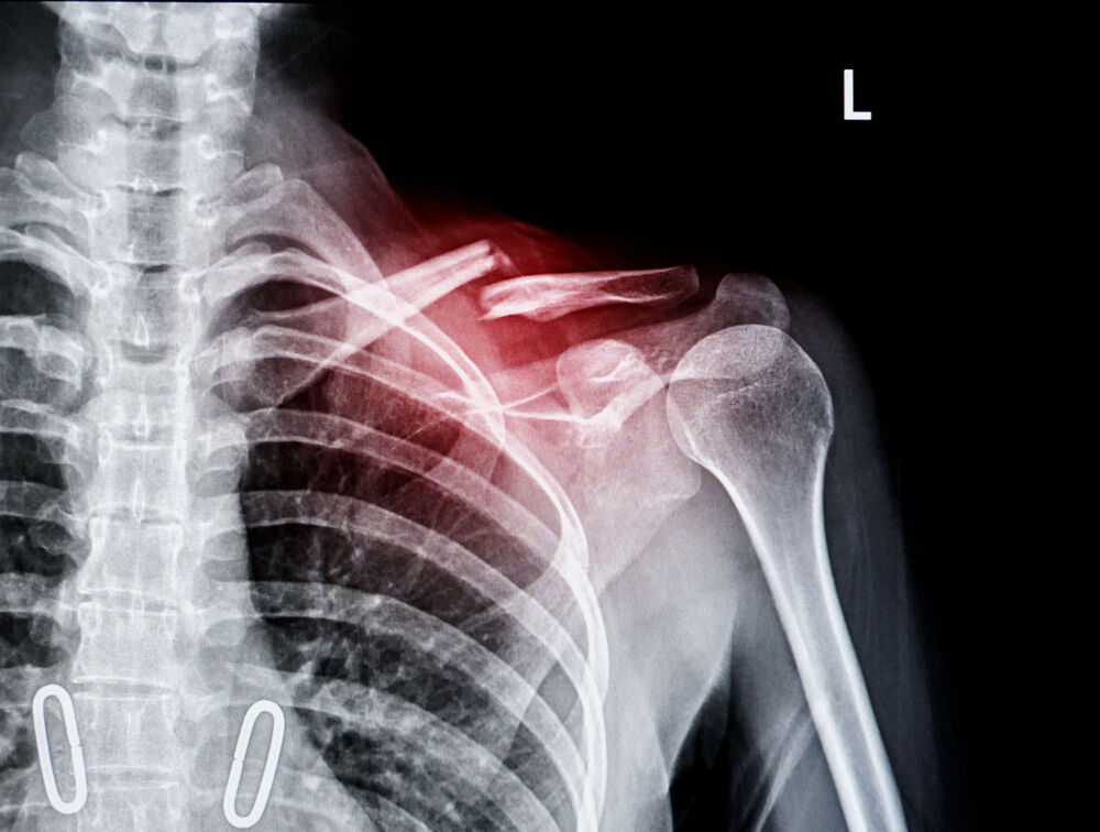 An X-ray showing a fractured bone.