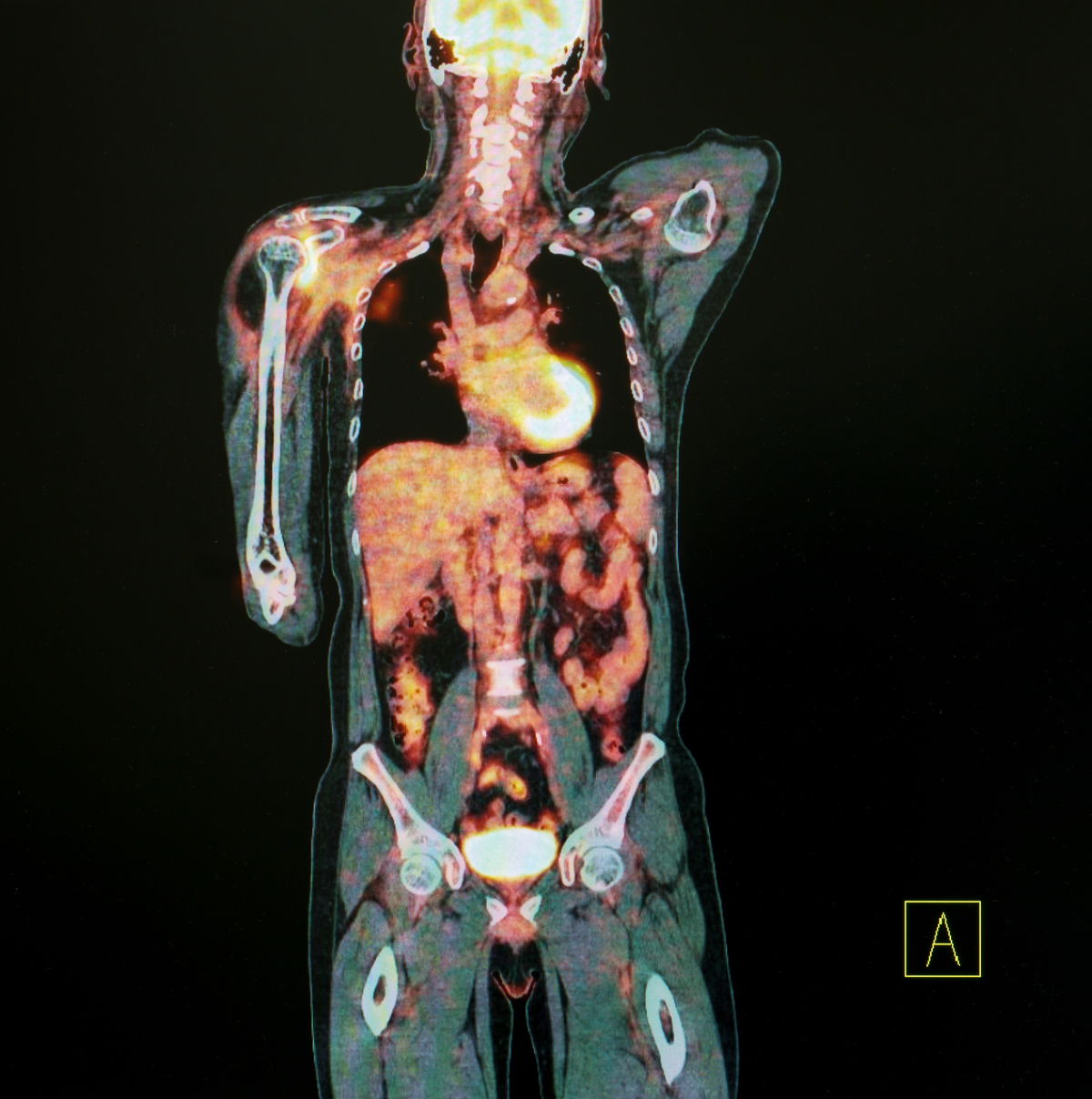 Positron emission tomography (PET) uses gamma rays