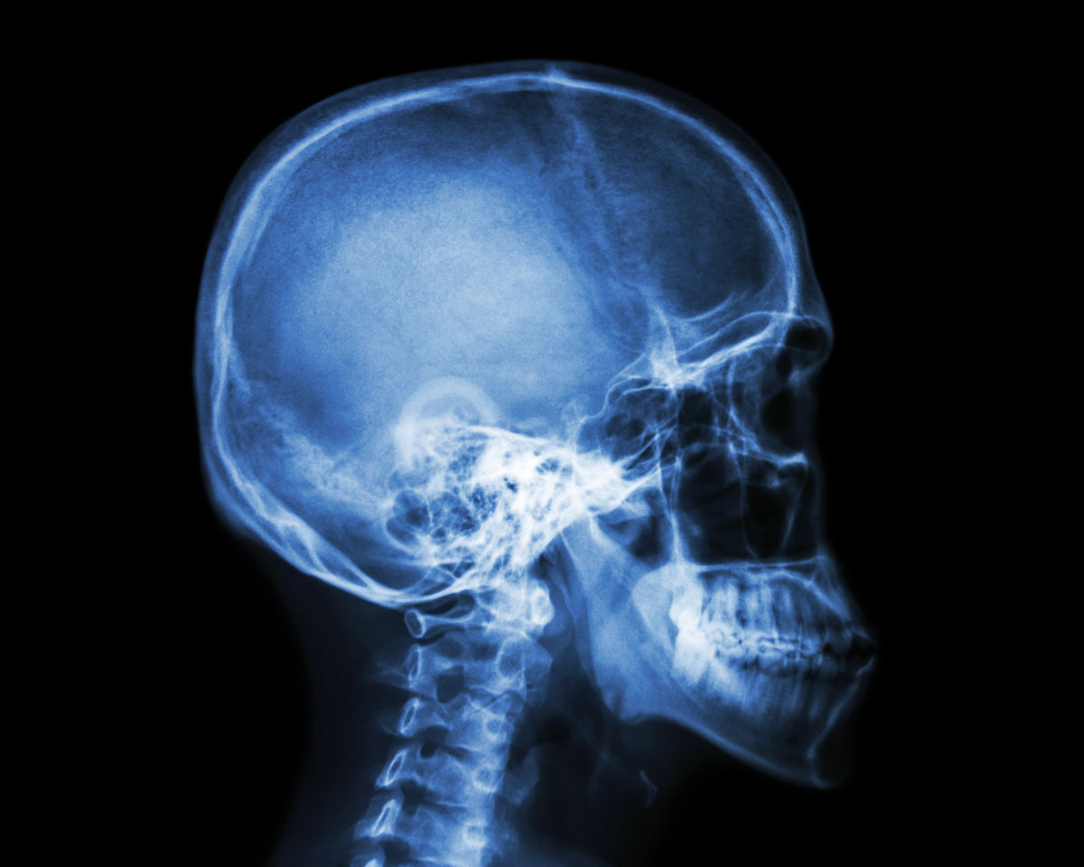 X-ray image of a patient’s skull