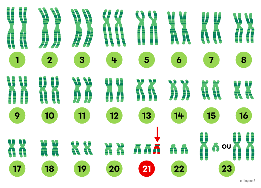 Le caryotype des chromosomes d’un être humain atteint de trisomie 21