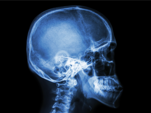 A skull x-ray.