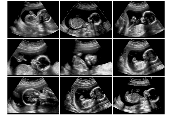 The sonogram of a fetus at 20 weeks.