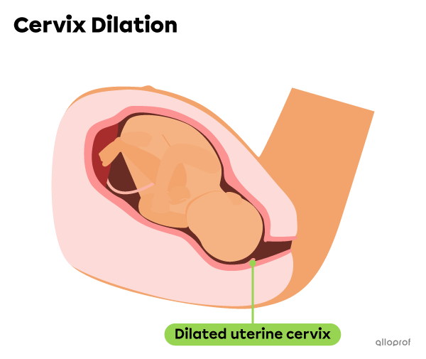 During the dilation stage, the cervix dilates.