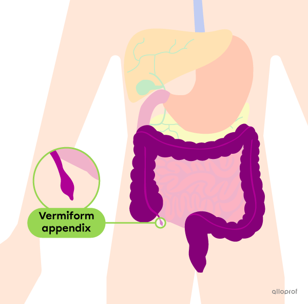 The inflammation of the vermiform appendix during appendicitis.