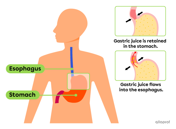 A burning sensation at the sternum level caused by the gastric juice rising up the esophagus.