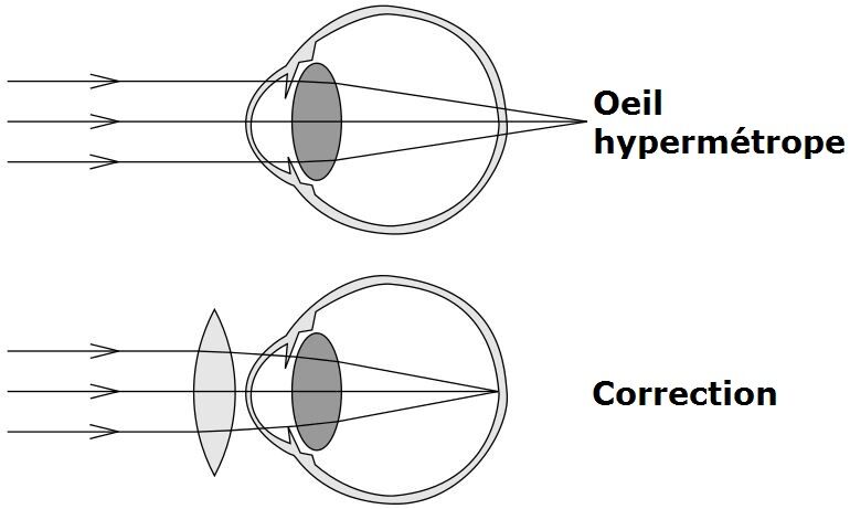 Hypermétropie