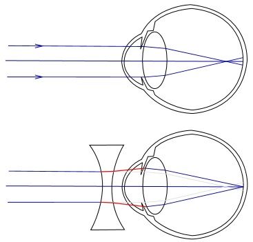 Myopia