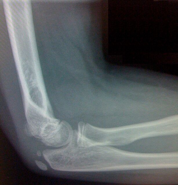 Some of the bones that make up the elbow are connected by freely movable joints.