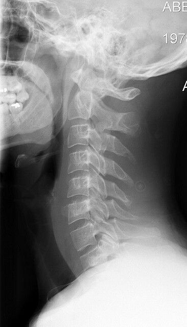 The joints between the vertebrae enable partial movement.