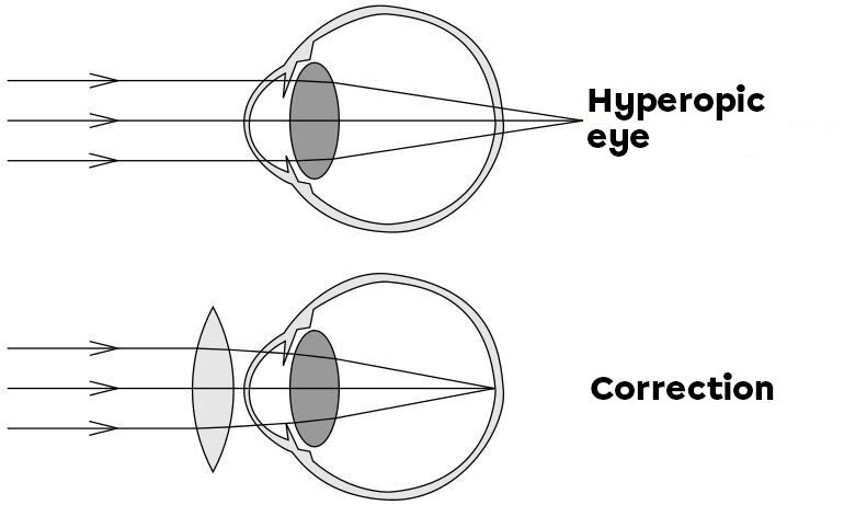 Hyperopia