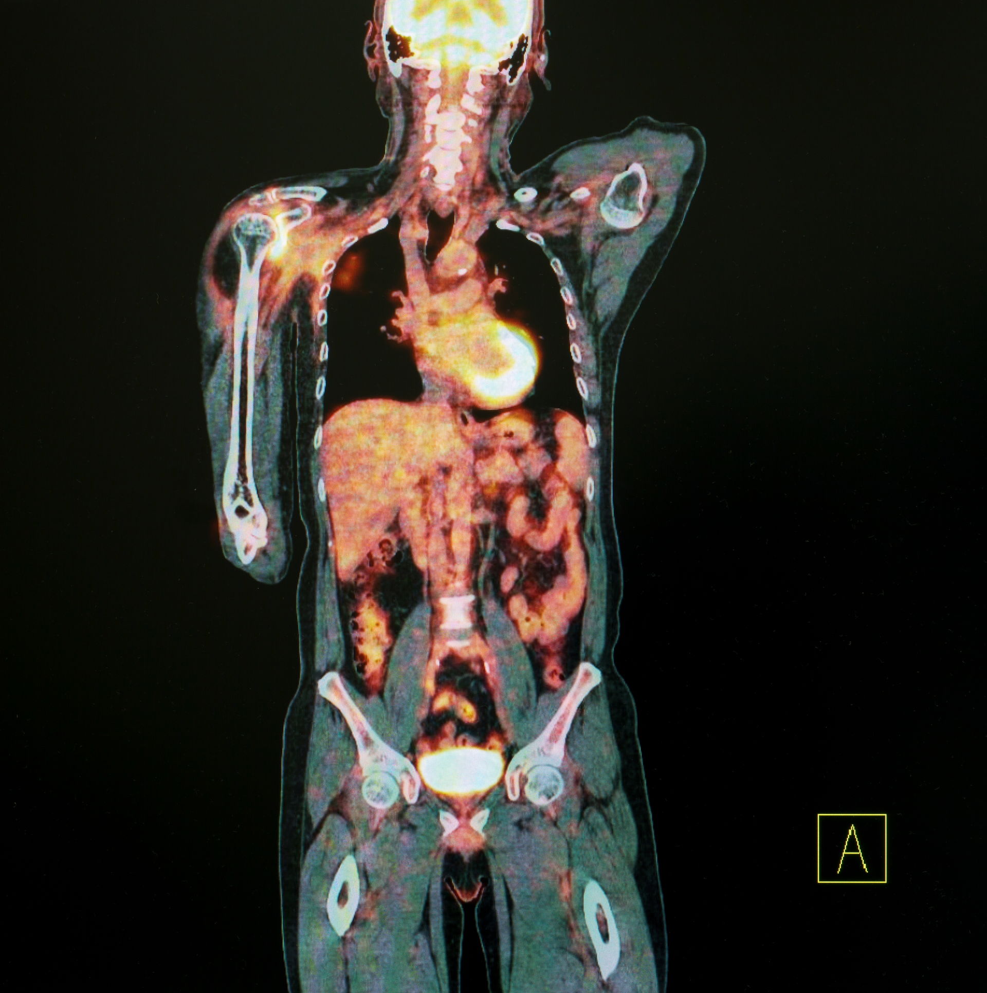La tomographie par émission de positons (TEP) exploite les rayons gamma.
