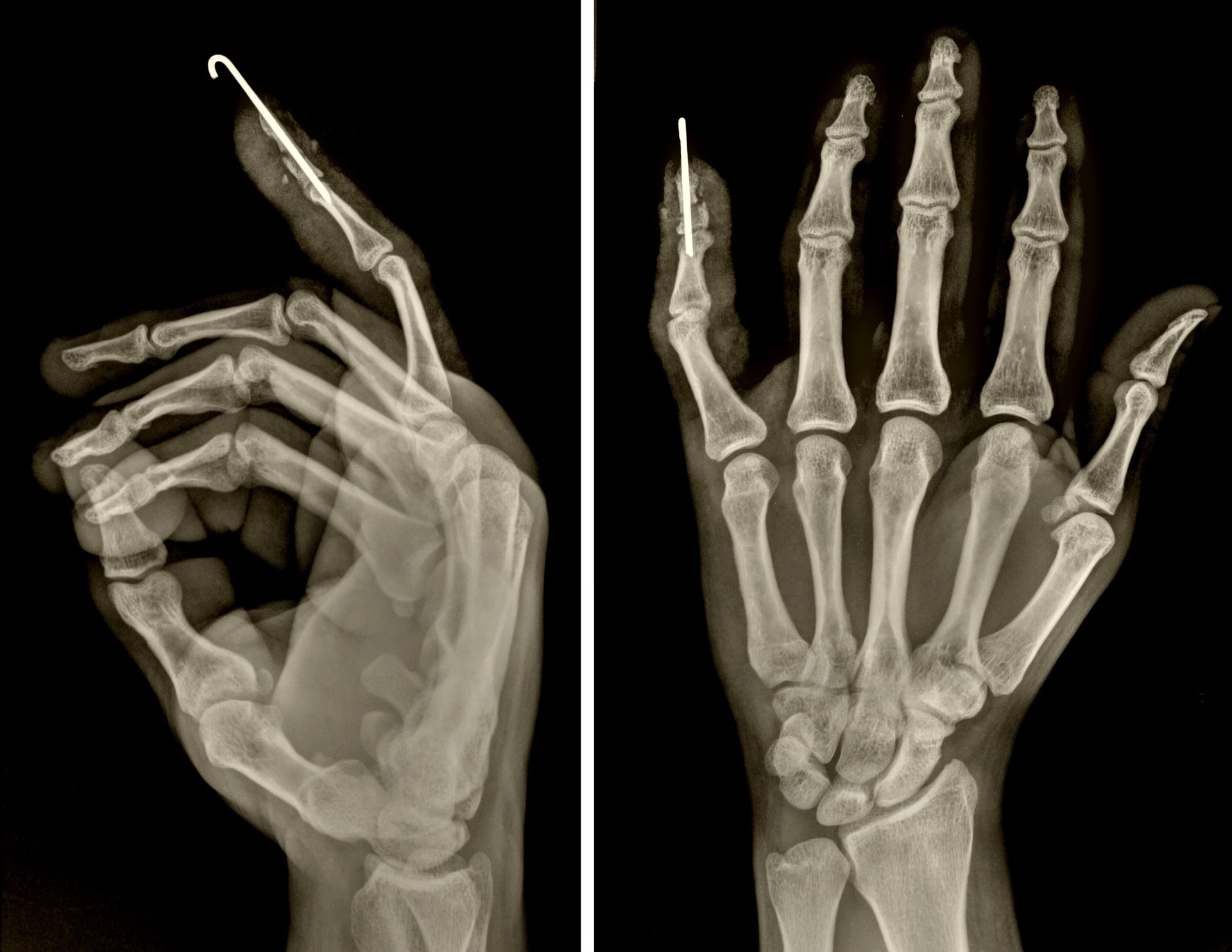 X-ray of a hand.