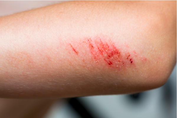 Mitosis allows the skin to repair itself by cloning somatic skin cells.