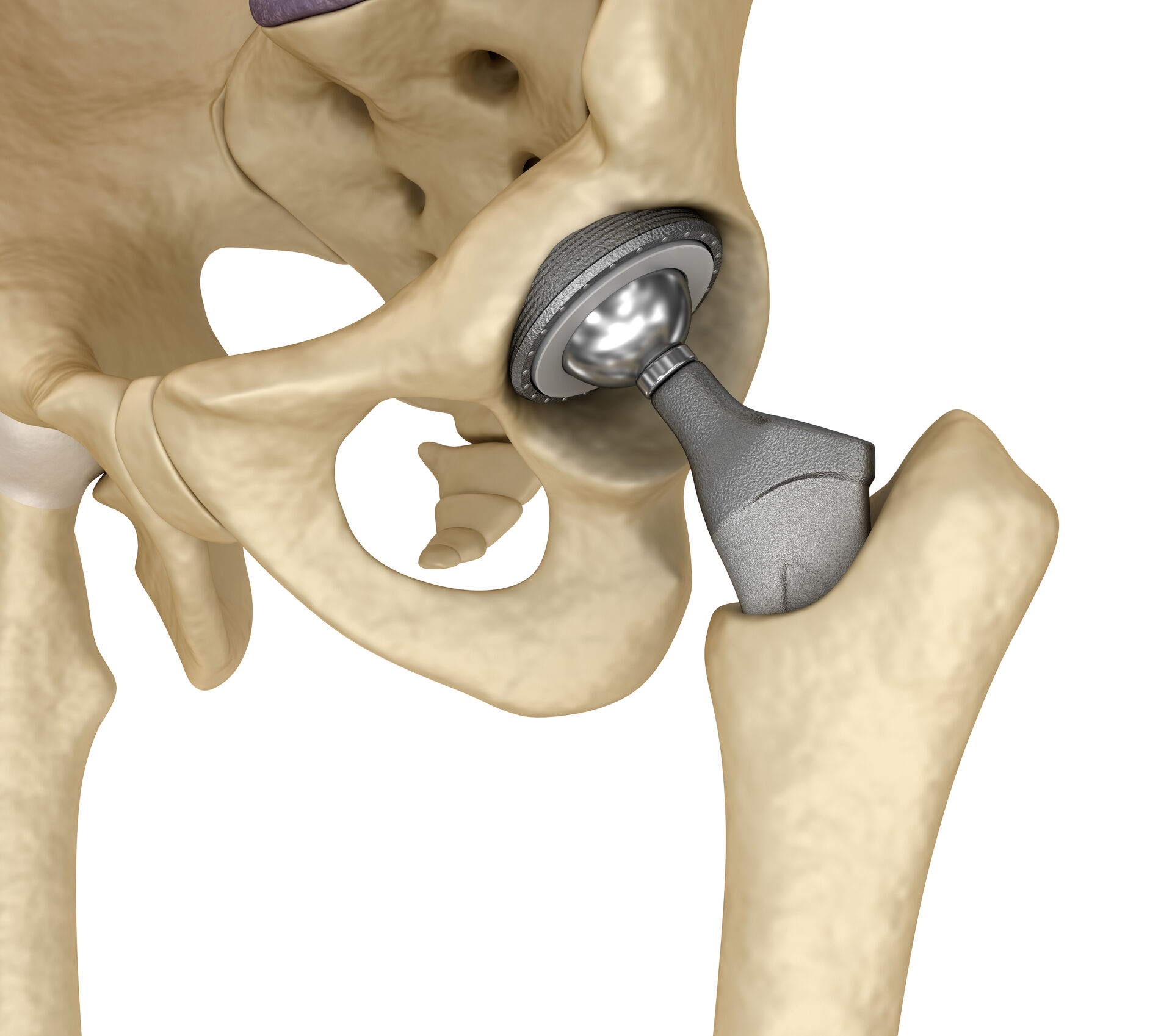 Titanium hip prosthesis